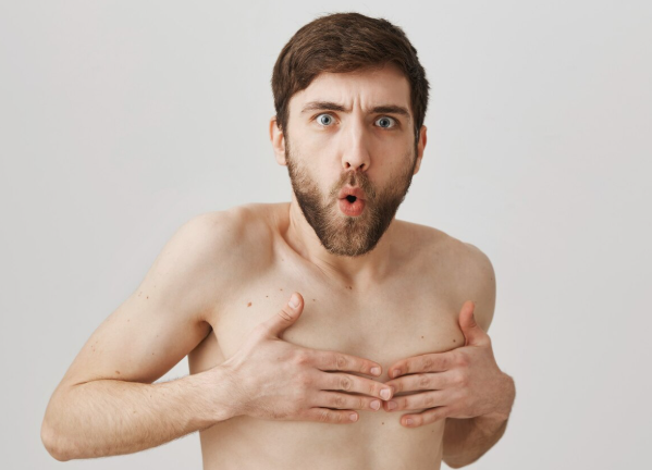 gynecomastia